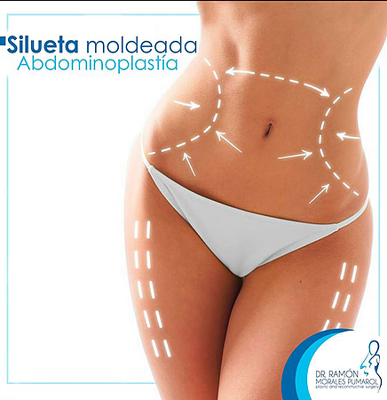 Abdominoplastia