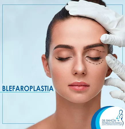 Blefaroplastia