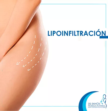 Lipoinfiltración