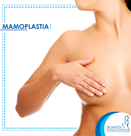 MAMOPLASTIA