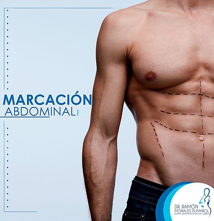 MARCACION ABDOMINAL