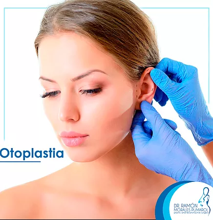 Otoplastia